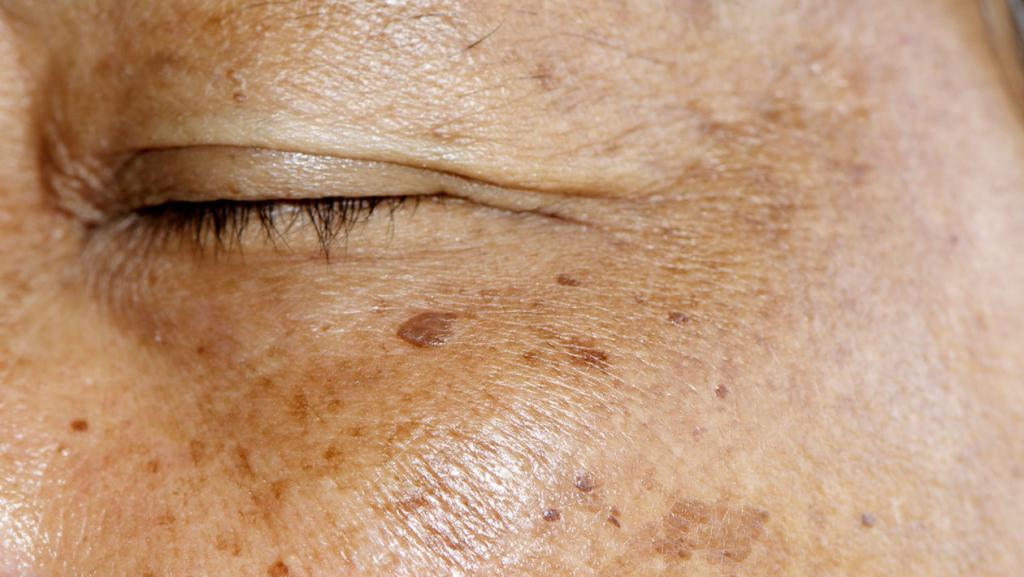 درمان خانگی لکه های تیره پوست