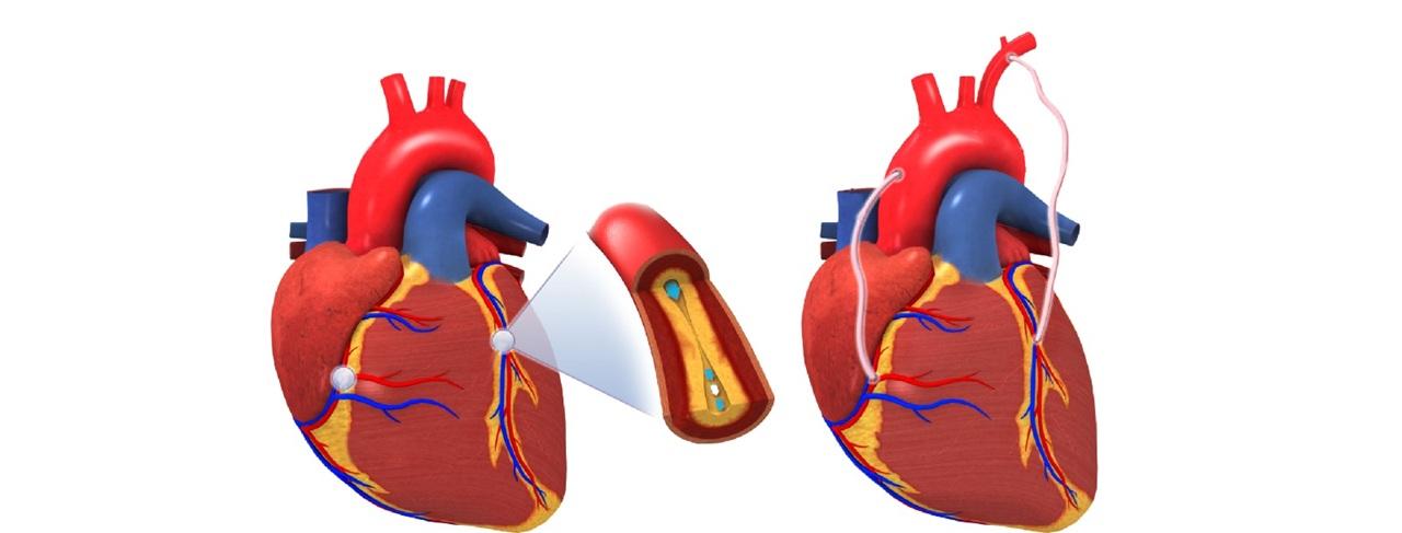 چگونه از ایست قلبی پیشگیری کنیم؟