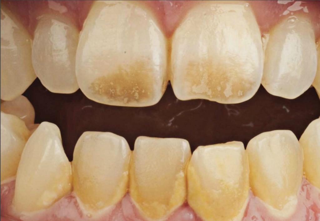 علت سیاه شدن  دندان ها از داخل