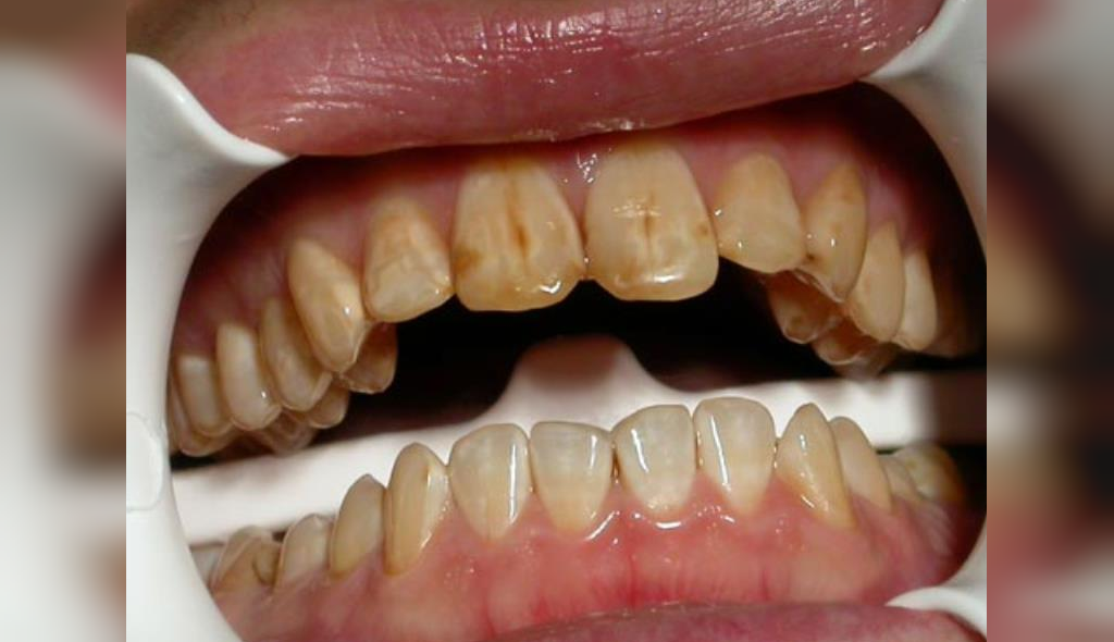 لکه های سیاه روی دندان
