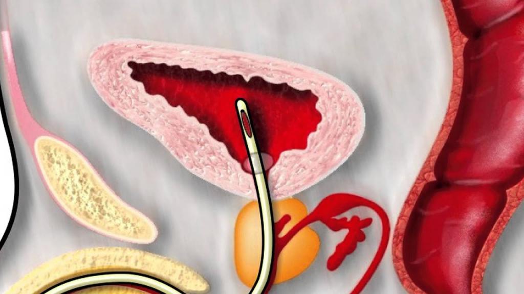 پروستاتکتومی چیست، انواع روش های و خطرات آن