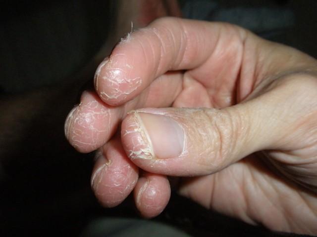 7. پوسته پوسته شدن نوک انگشتان بخاطر اگزمای دست: