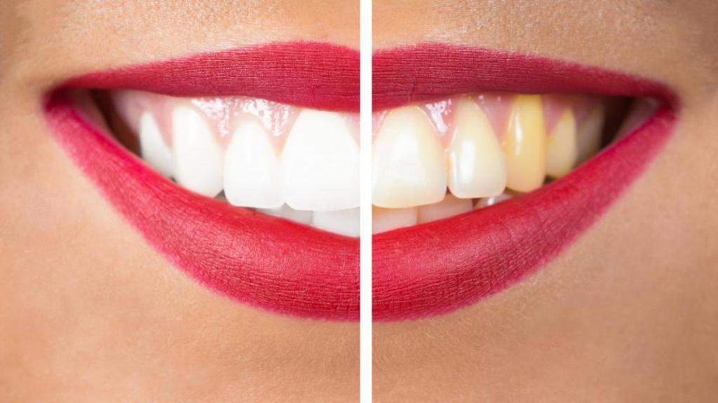 چگونه دندان ها لکه دار یا زرد می شوند؟