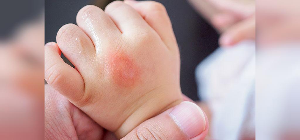 علل بروز حساسیت پوستی در نوزادان