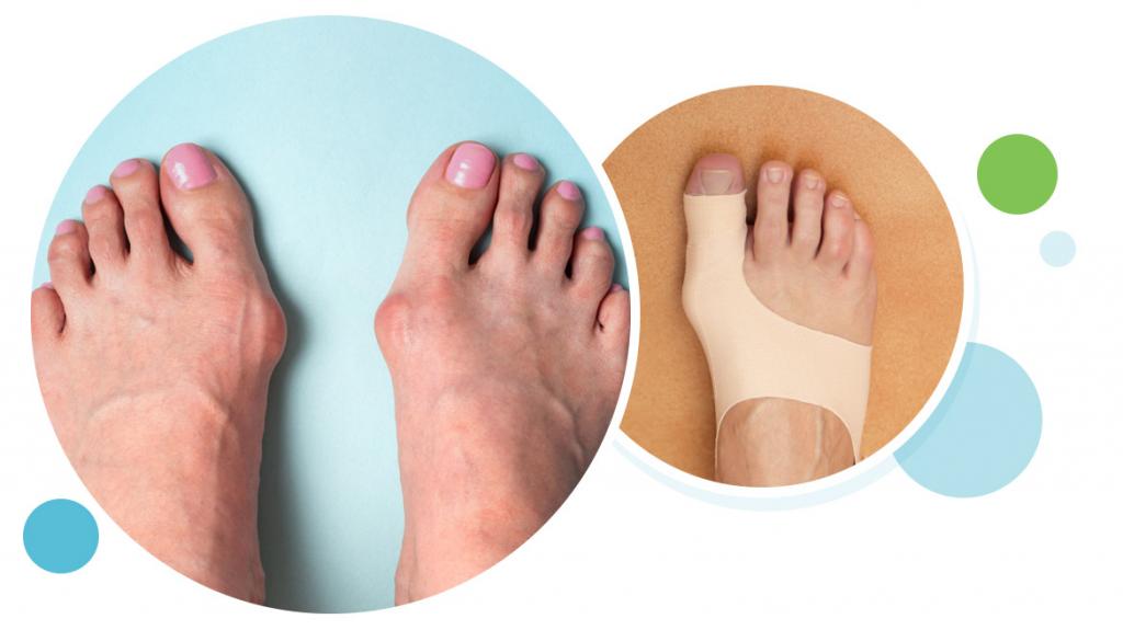 آیا درمانی برای انحراف شست پا وجود دارد؟