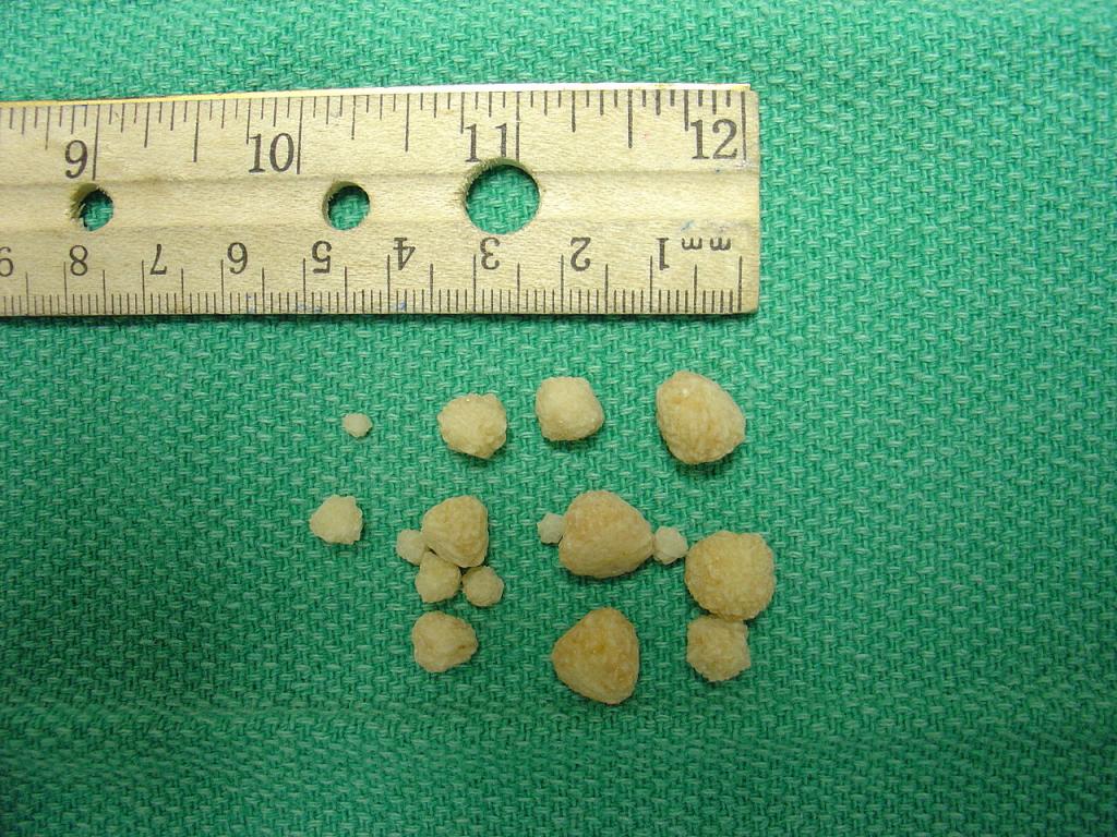 درمان سنگ مثانه:خارج کردن سنگ با جراحی