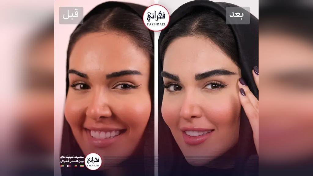 نمونه کاشت ابرو در کلینیک های زیبایی