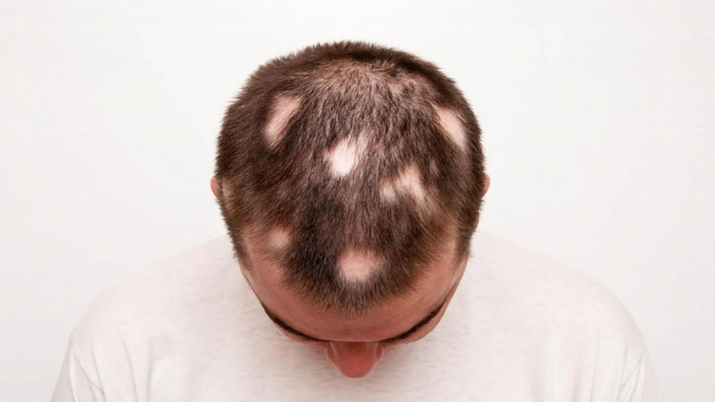 علت ریزش مو سکه ای؛ درمان خانگی ریزش سکه ای مو با طب سنتی