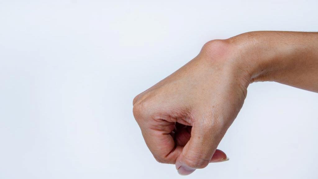 علائم و درمان کیست گانگلیون مچ دست چیست