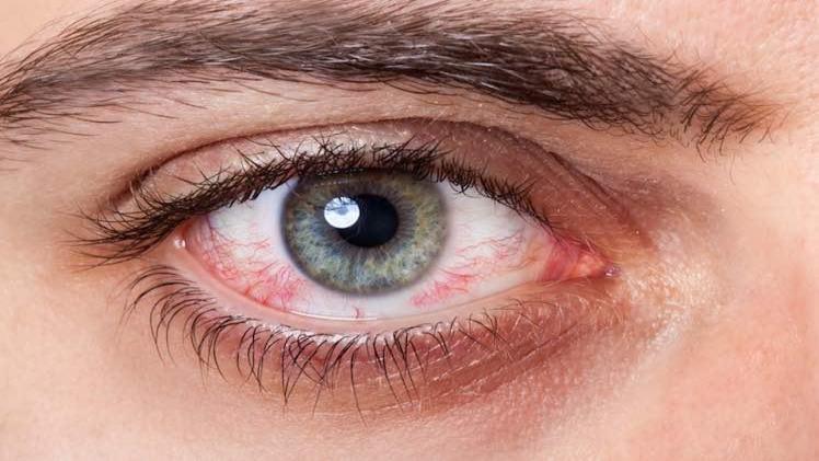 18 علت قرمز شدن چشم + درمان لکه خون در چشم