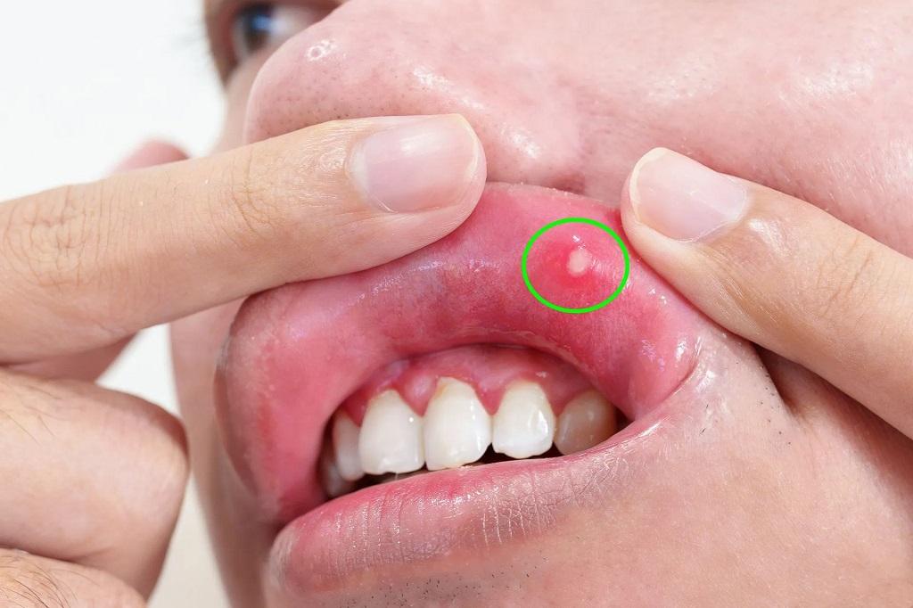آیا آفت دهان از علائم بارداری است