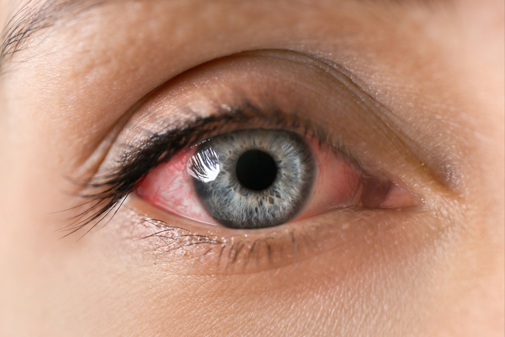 علائم تولارمی چشمی:قرمزی چشم