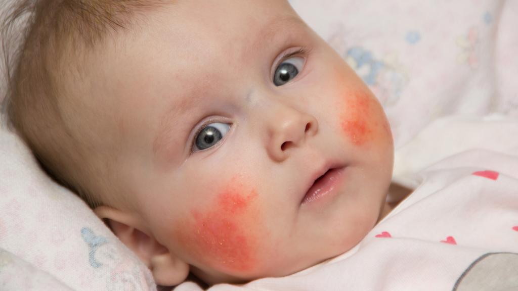 رایج ترین حساسیت پوستی در نوزادان
