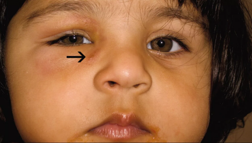 عفونت چشم در کودکان چند ورز طول می کشد؟