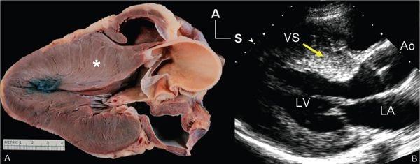 عوامل سکته قلبی در نوجونان 1