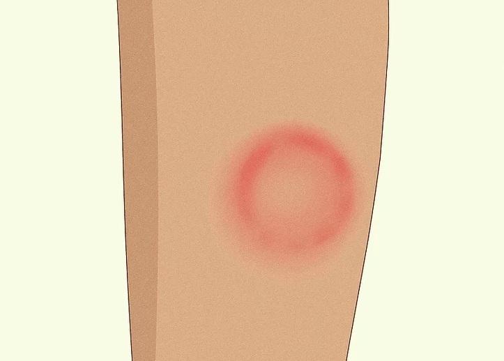 علت شایع خارش پاها  7