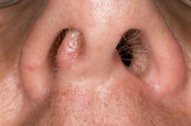 چه کسانی نیازمند جراحی سینوس&zwnj;اند؟