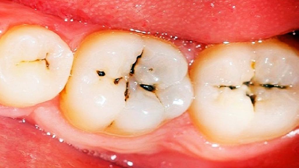 جلوگیری از پیشروی پوسیدگی دندان