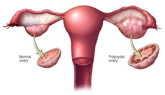 علائم سندرم PCOS 