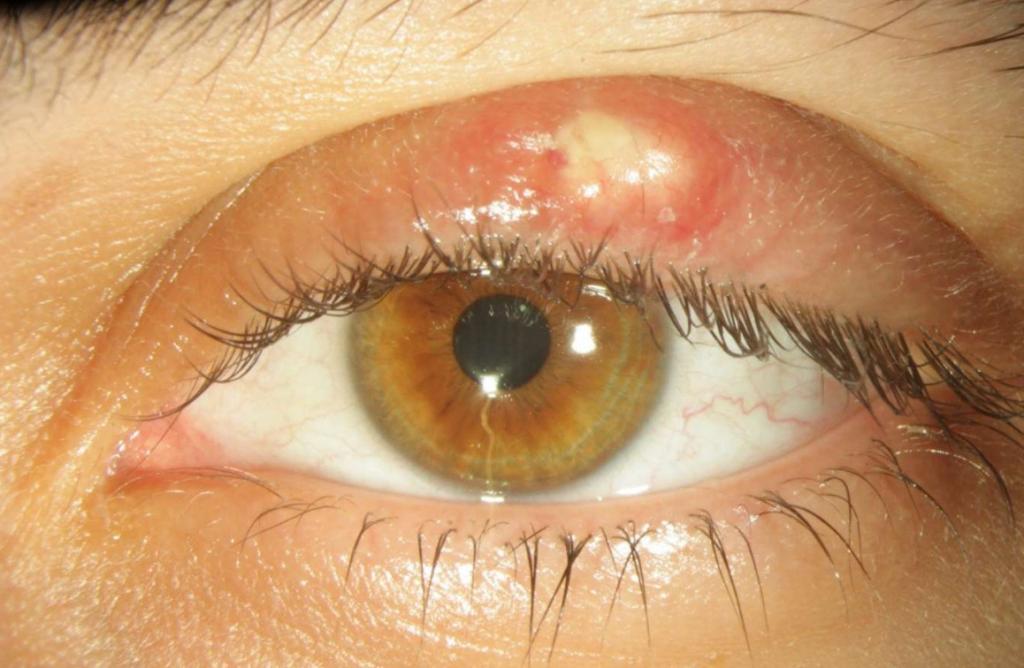 تورم پلک چشم و درمان آن