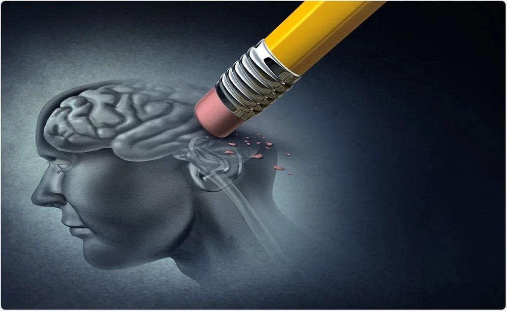 آلزایمر چیست