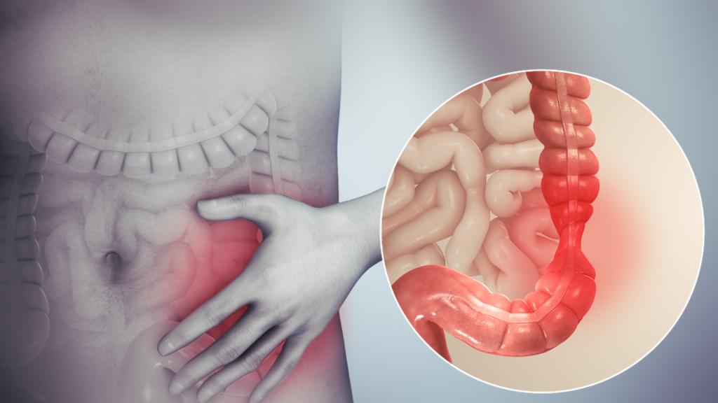 مبورین (Mebeverine) موارد مصرف