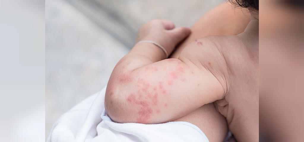 آلرژی های پوستی در نوزادان