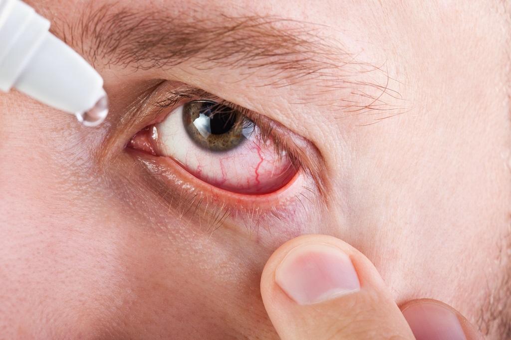 درمان عفونت چشم با داروهای گیاهی