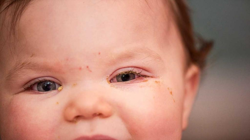 علل ترشحات چشم در نوزادان