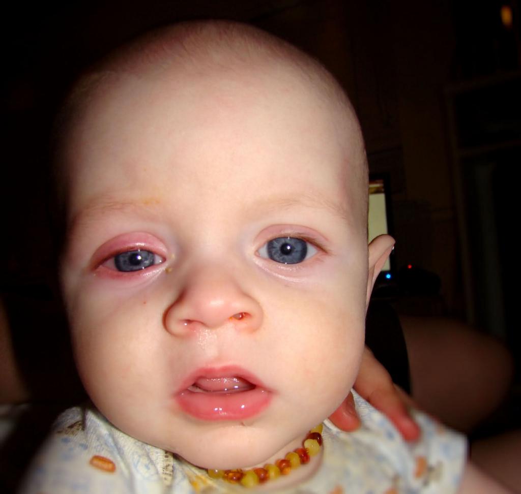 چه زمانی برای اشک چشم کودک باید به پزشک مراجعه کرد؟