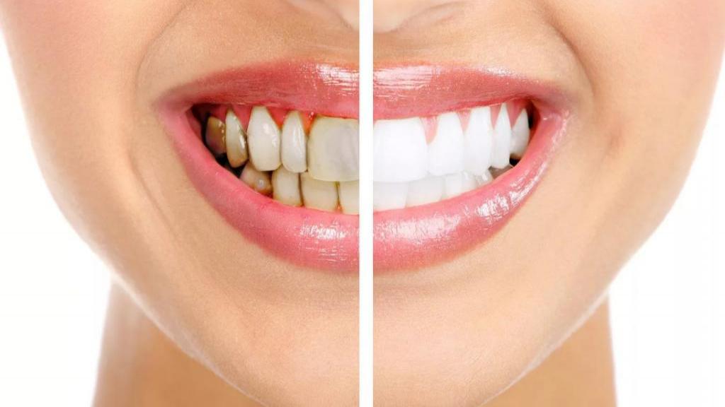 لکه های سیاه روی دندان؛ علت و روش های ازبین بردن لکه های سیاه روی دندان