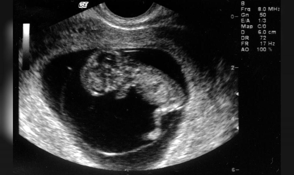 8 недель и 4 дня. Снимок УЗИ эмбриона на 8 неделе беременности. УЗИ на 11 акушерской неделе беременности. УЗИ 8-9 недель беременности. УЗИ плода 12 акушерских недель беременности.