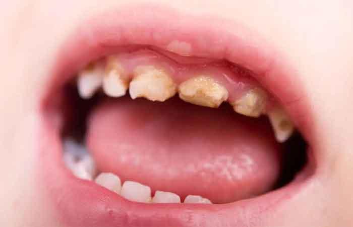  عوارض رفلاکس معده: پوسیدگی دندان