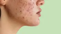 چه کار کنیم قبل از پریودی جوش نزنیم؛ جلوگیری از آکنه پیش از قاعدگی