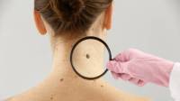علائم ملانوما چیست؛ علت، تشخیص و درمان سرطان پوست ملانوما