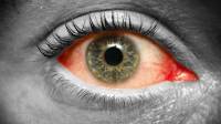 علت و درمان عفونت چشم با داروی گیاهی، خانگی، پماد و طب سنتی