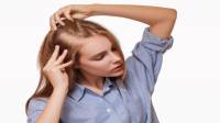 علت بیماری آلوپسی چیست + پماد و آمپول برای ریزش موی سکه ای