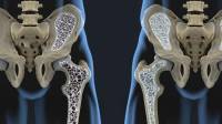 علائم پوکی استخوان در زنان و مردان؛ علت، عوارض و درمان پوکی استخوان